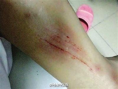 修车1000自掏还是保险 车子轻微擦伤对方非要走保险维修