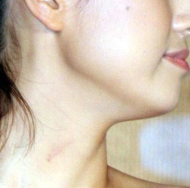 照片显示,希尔顿腿上,腰上有明显的红痕,连脸上都不能幸免.